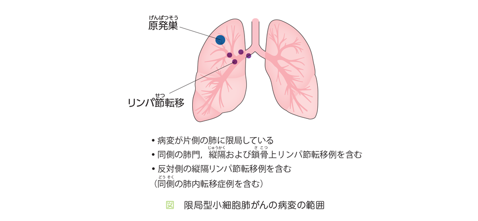 リンパ 鎖骨 節 上 リンパ節腫脹