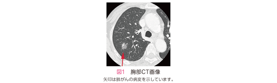 肺HRCTエッセンシャルズ 読影の基本と鑑別診断 医学一般その他